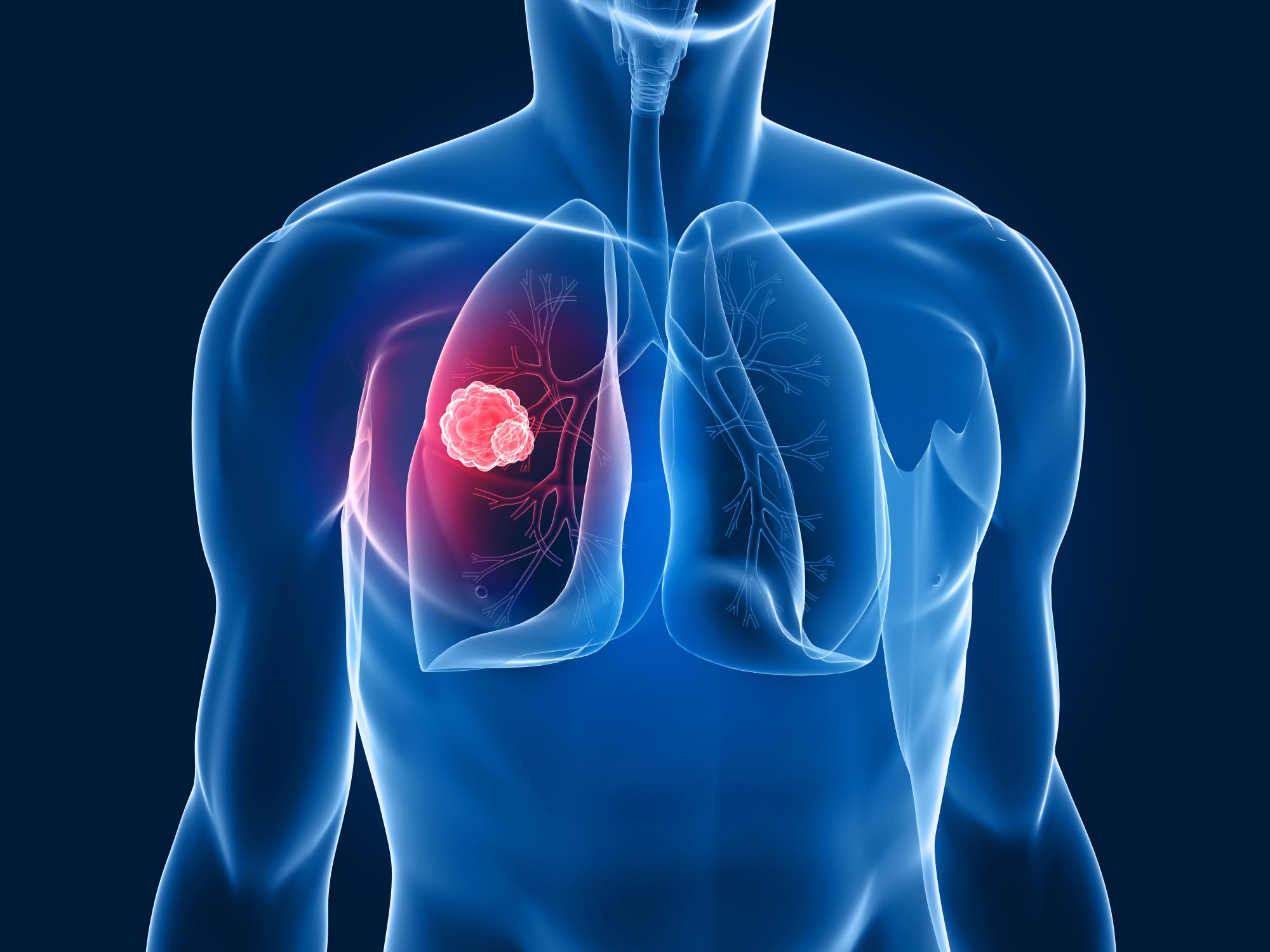 Graphic of lung cancer